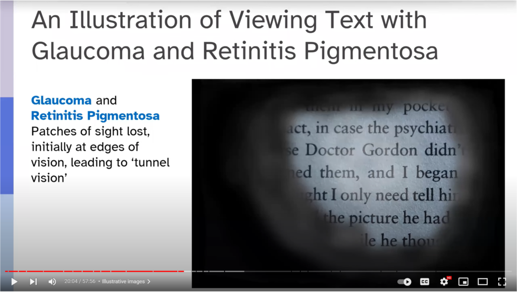 An illustration of viewing text with glaucoma and retinitis pigmentosa. Patches of sight lost, initially at edges of vision, leading to "tunnel vision"