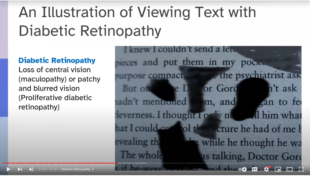 An illustration of viewing text with diabetic retinopathy. Loss of central vision (maculopathy) or patchy and blurred vision (proliferative diabetic retinopathy)
