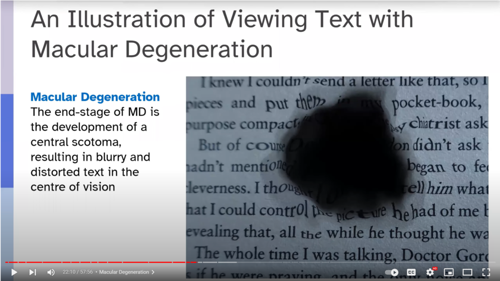 An illustration of viewing text with macular degeneration. The end stage of macular degeneration is the development of a central scotoma, resulting in blurry and distorted text in the center of vision.